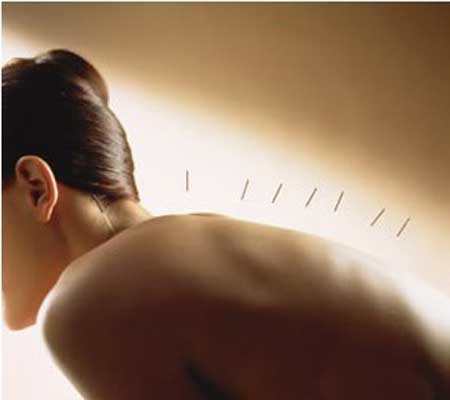 针灸减肥有隐患_可能会传染疾病