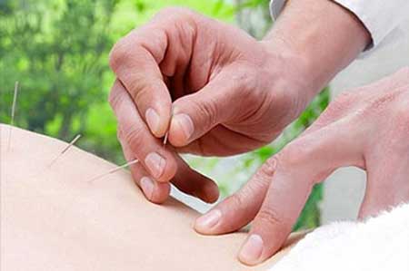 针灸减肥的优势_健康安全减肥方式首选