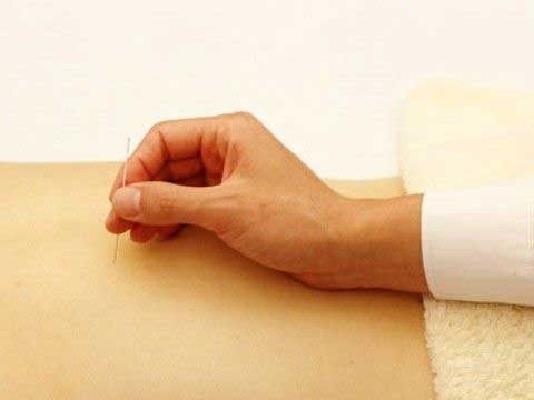 针灸减肥效果独树一帜_四种常见减肥手法