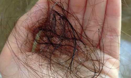 脱发严重不要妄想用护法产品就会好，做好这几点才是真的