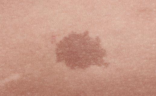 身上长胎记竟暗藏杀机 小心胎记可能是疾病信号