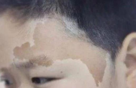 身上长这种颜色胎记竟暗藏杀机 小心胎记可能是疾病信号