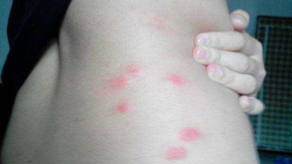 皮肤过敏怎么办？教你5招轻松应对过敏！