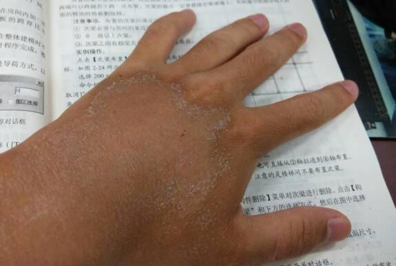 皮肤晒伤后怎么处理?这4种措施让你轻松修复!