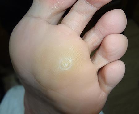 脚上长鸡眼怎么办？脚底长鸡眼的2个根治秘方