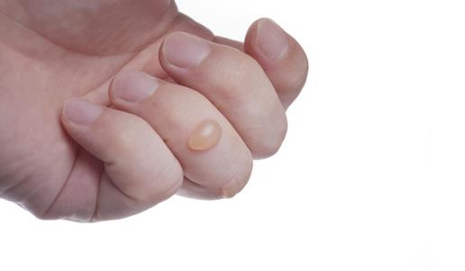 民间烫伤小偏方真的管用吗