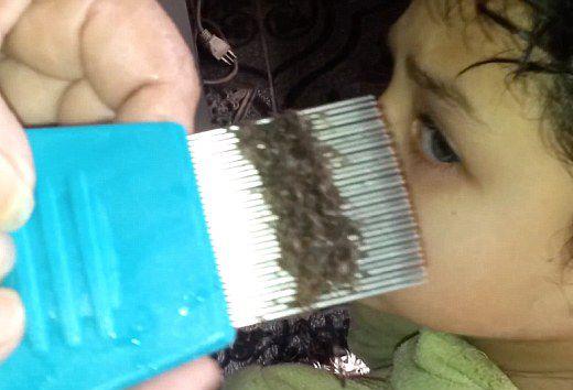 头上长虱子怎么去除 去虱子和虱子卵的有效方法