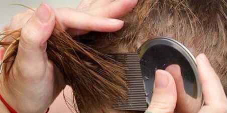 头上长虱子怎么去除 去虱子和虱子卵的有效方法