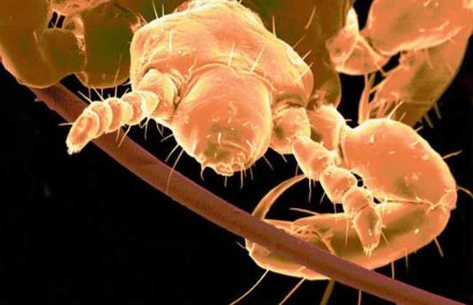 头上长虱子怎么去除 去虱子和虱子卵的有效方法