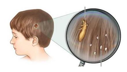 头上长虱子怎么去除 去虱子和虱子卵的有效方法