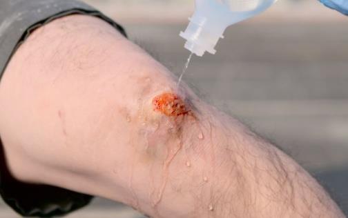 伤口总是不愈合是有原因的 伤口处理原则和正确步骤