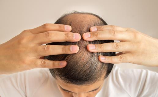 改善脱发是场持久战 解决长期脱发问题有妙招