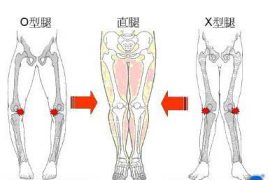 5种走路姿势会让你变成O型腿