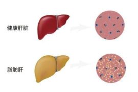 脂肪肝的治疗方法 应酬男应该看看