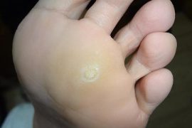 脚上长鸡眼怎么办？脚底长鸡眼的2个根治秘方