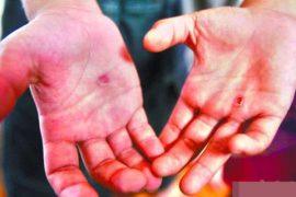 手上长水泡马上去医院 预防汗疱疹时的八大注意细
